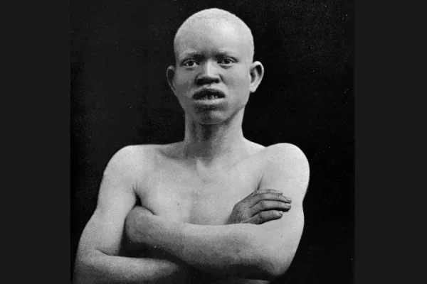 albino