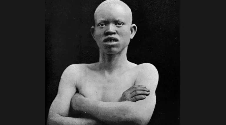 albino