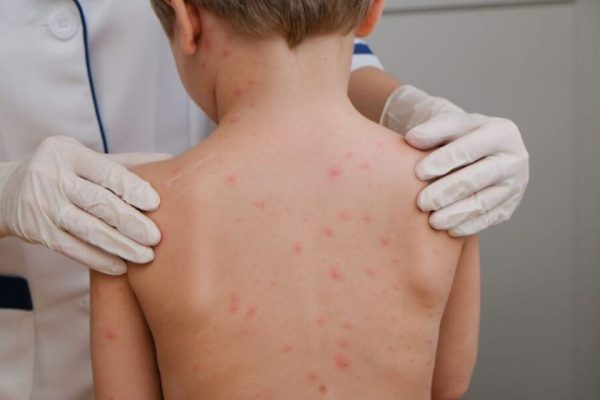 crianc-a-meningite-meningoco-cica