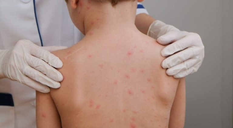 crianc-a-meningite-meningoco-cica